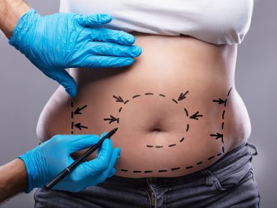 Close-up Of Plastic Surgeon In Blue Gloves Drawing On Woman's Stomach With Pen For Surgery